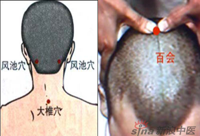 常見(jiàn)病艾灸時(shí)怎樣選穴？--大椎百會(huì)穴