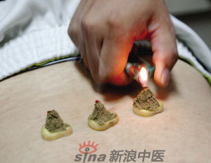 灸法的種類  你知道多少？